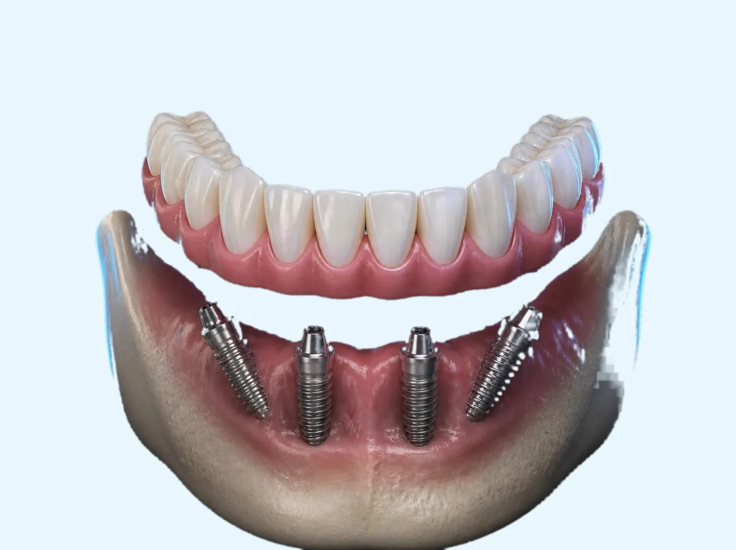 3D illustration of an All-on-4 bridge above four implants in the lower jaw, the back two angled
