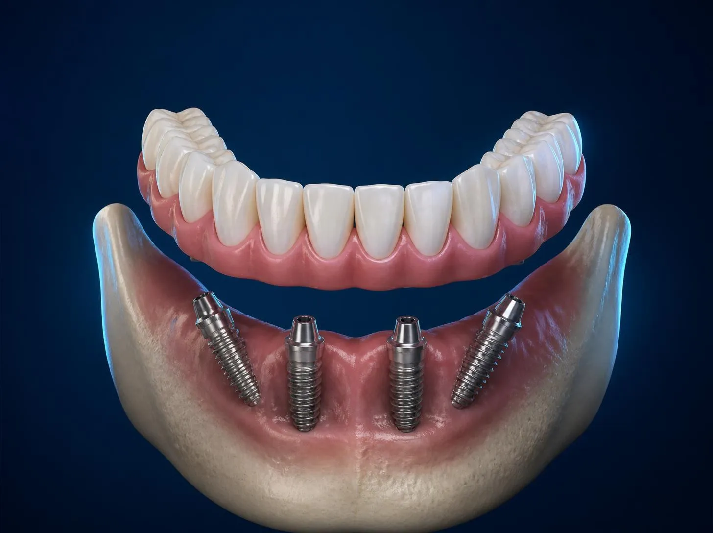 3D illustration of an All-on-4 full-arch bridge above four implants in the lower jaw, the back two angled