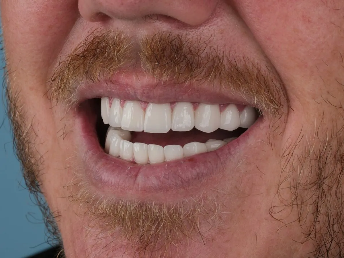 Close-up of a UK Smiles All-on-4 patient smiling with his new full arch of teeth