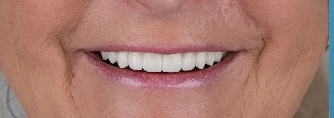 Close-up of a patient’s smile after All-on-4 treatment