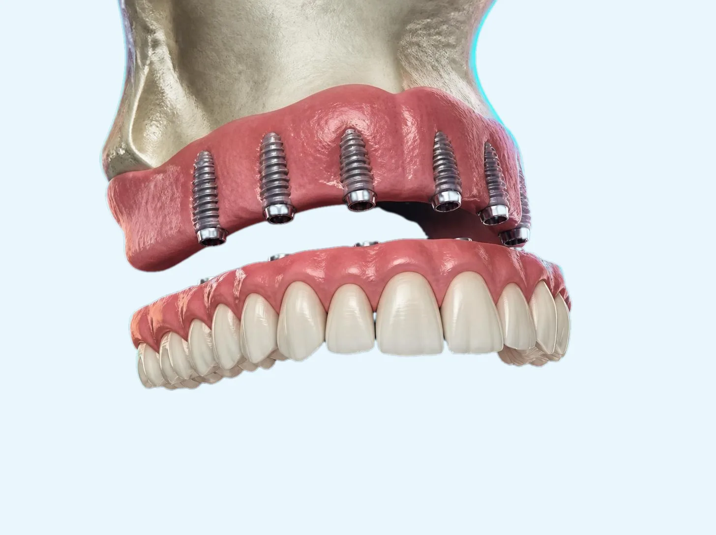 3D illustration of an All-on-6 bridge below implants in the upper jaw