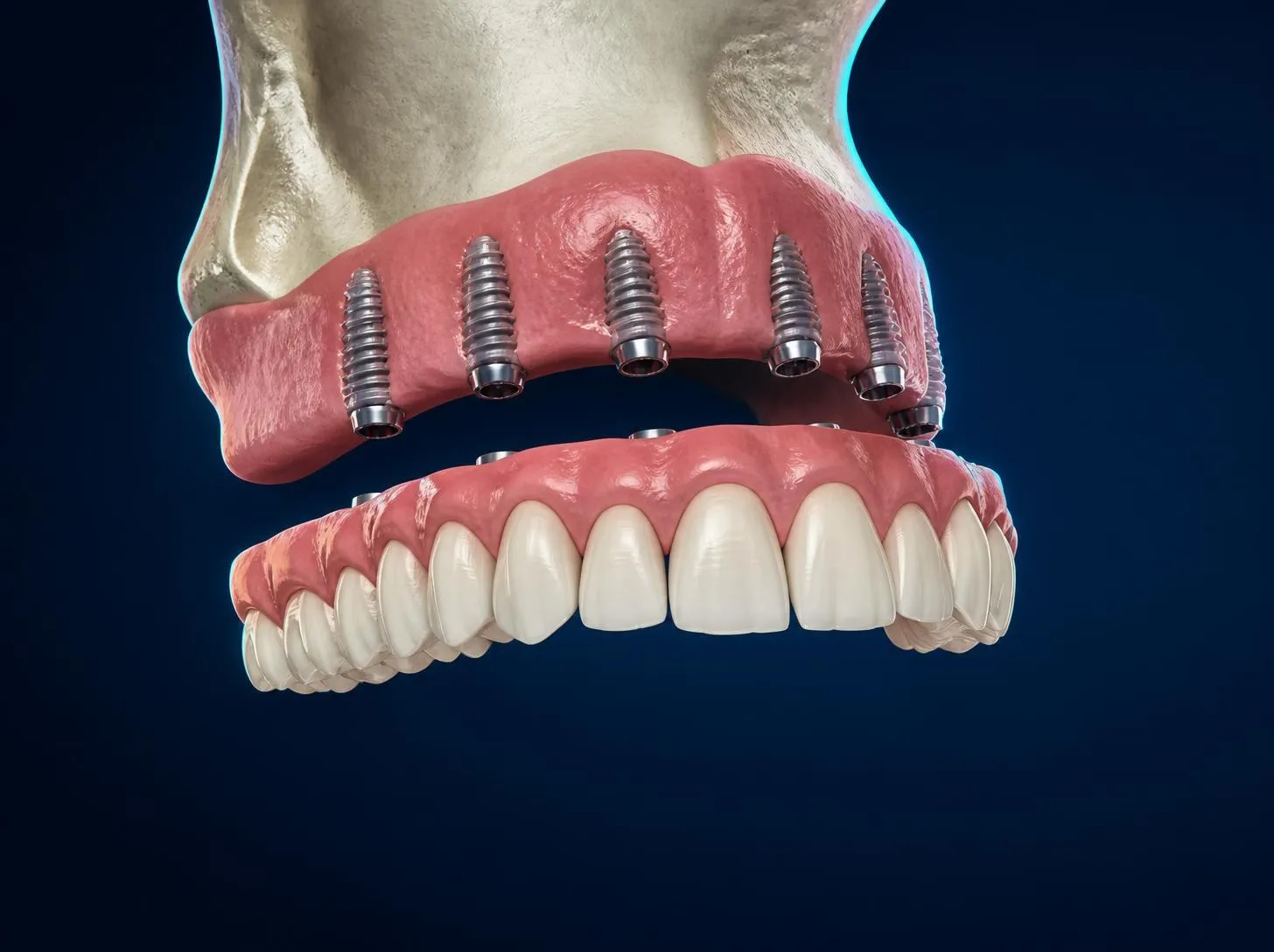 3D illustration of an All-on-6 bridge below six implants spread along the upper jaw
