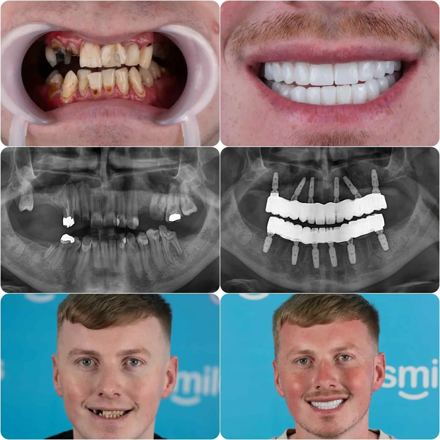 All-on-6 dental implants before and after, patient smile transformation with X-rays showing the six implants per arch and the full fixed bridge.