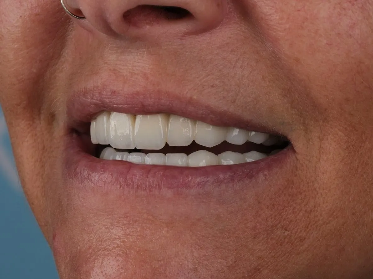 Close-up of a UK Smiles All-on-6 patient smiling with her new fixed teeth