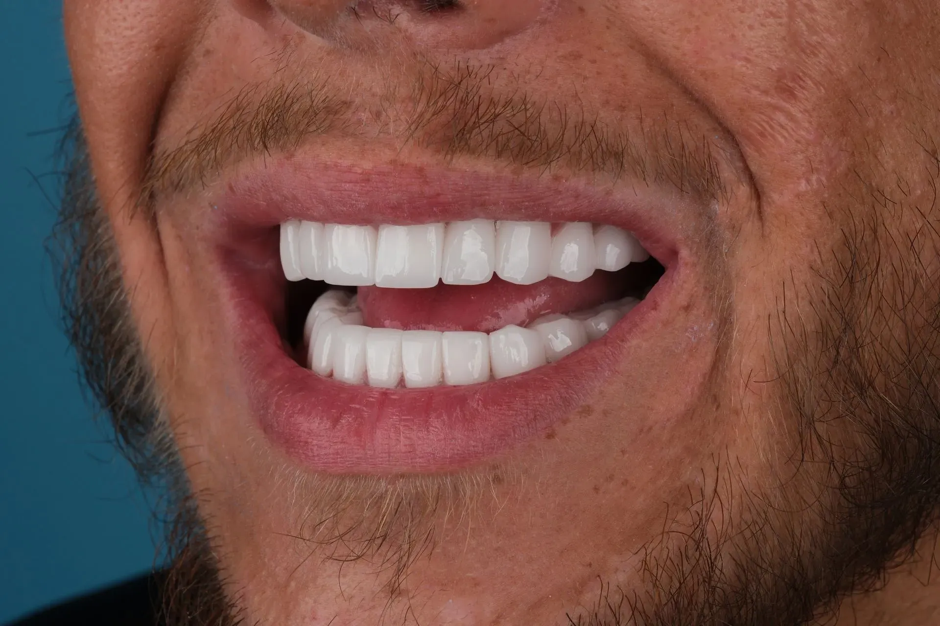 Close-up of a bearded man smiling, showing bright white teeth after All-on-6 treatment