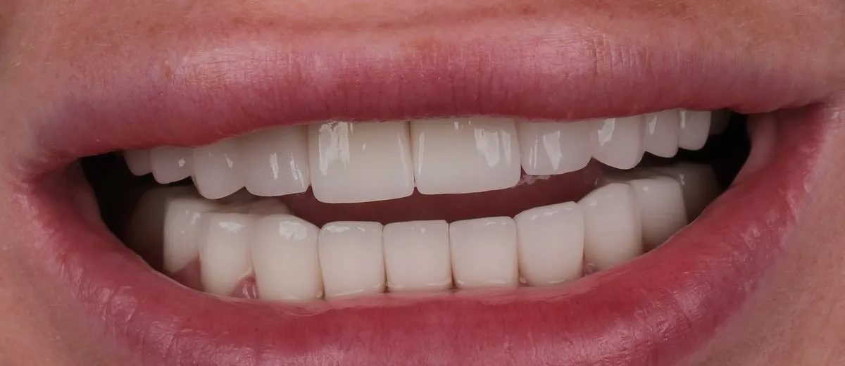 A UK Smiles patient's smile after treatment: BL3 shade, Softened style