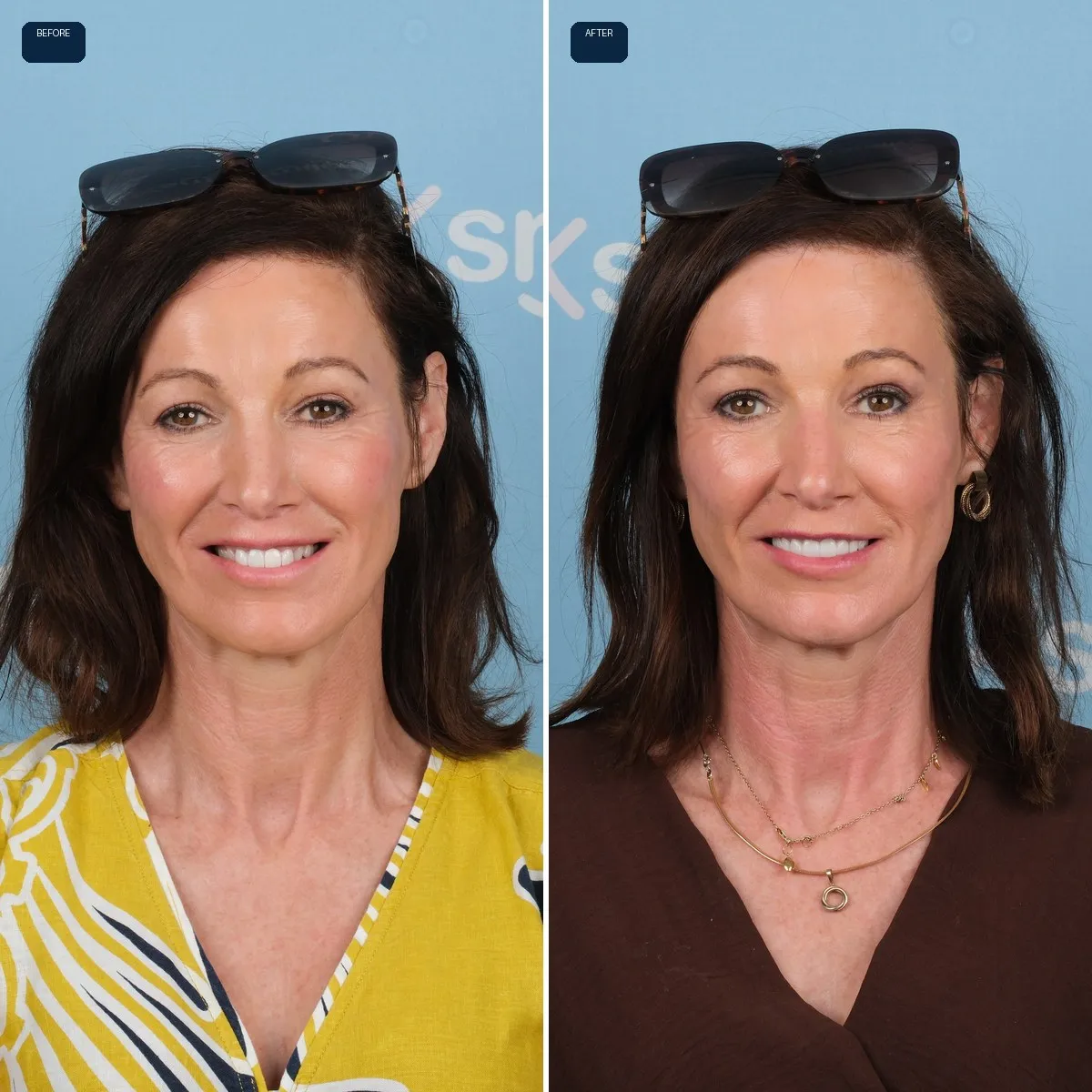 Anna's face before and after Dental Implants, Bridges and Zirconia Crowns at UK Smiles in Antalya