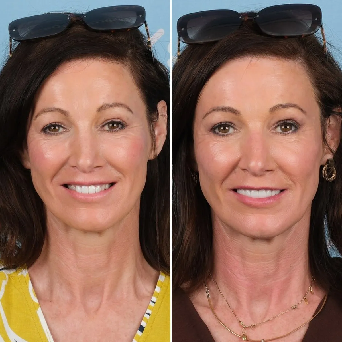 Anna before and after implants and crowns with UK Smiles