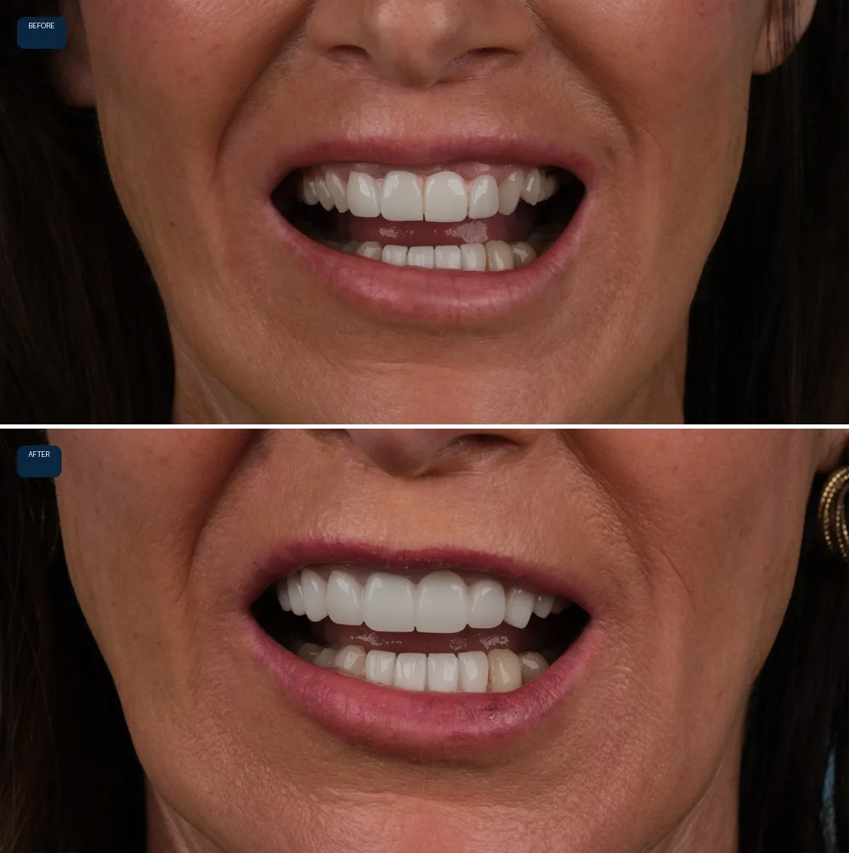Close-up of Anna's teeth before and after Dental Implants, Bridges and Zirconia Crowns, view 1