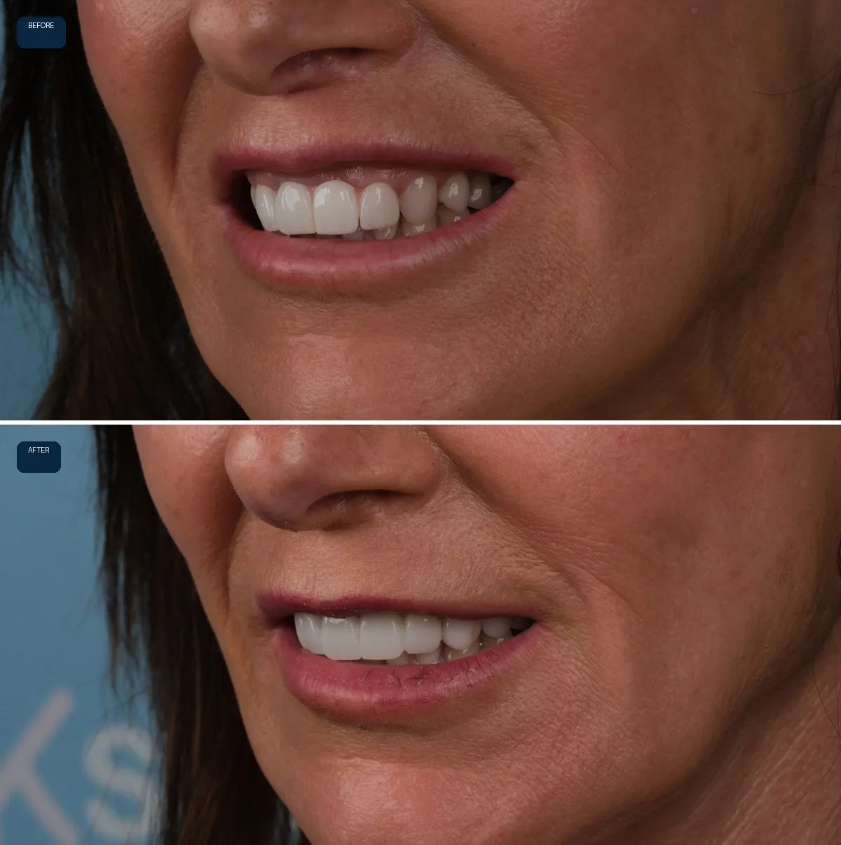 Close-up of Anna's teeth before and after Dental Implants, Bridges and Zirconia Crowns, view 2