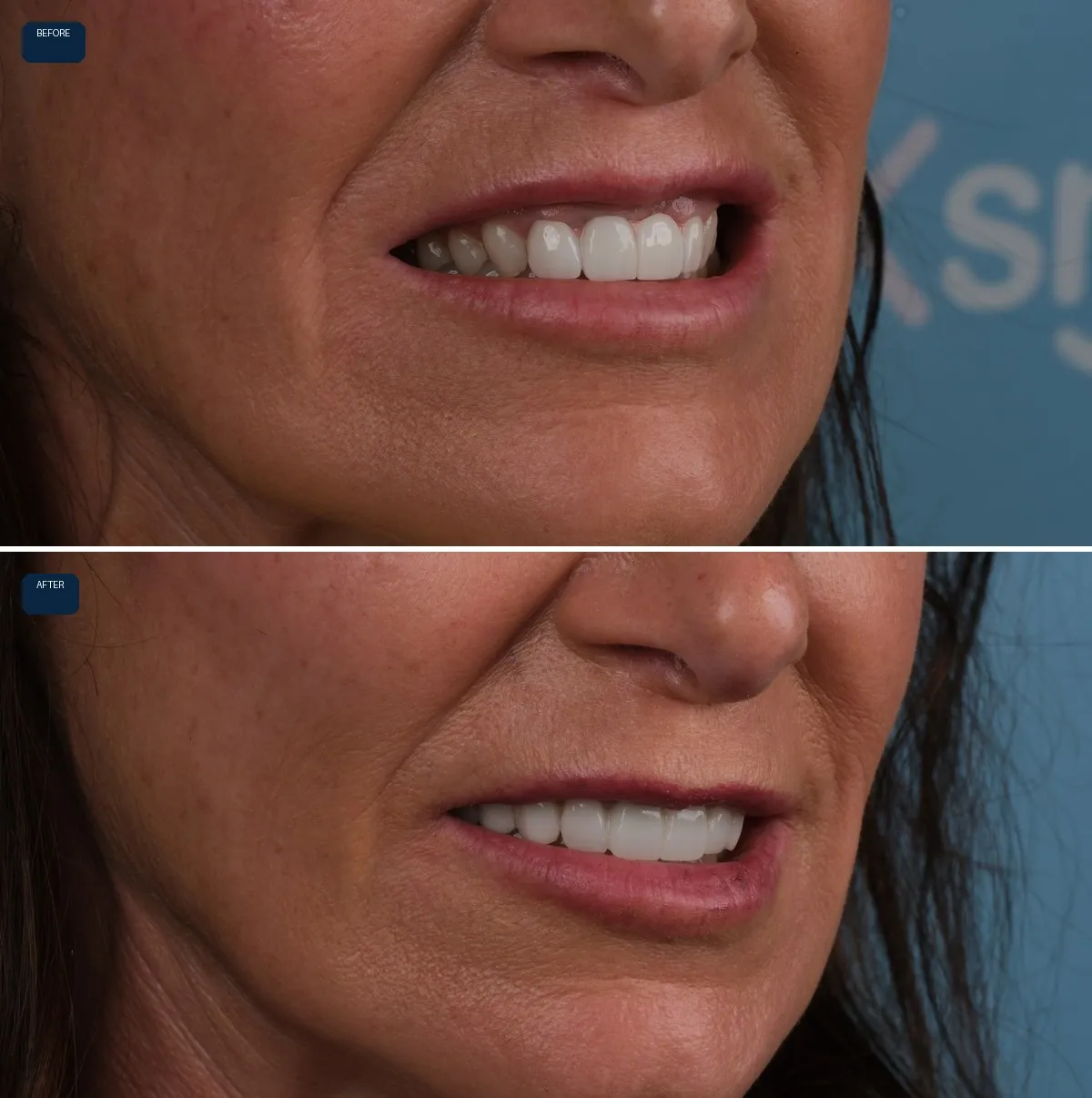 Close-up of Anna's teeth before and after Dental Implants, Bridges and Zirconia Crowns, view 3