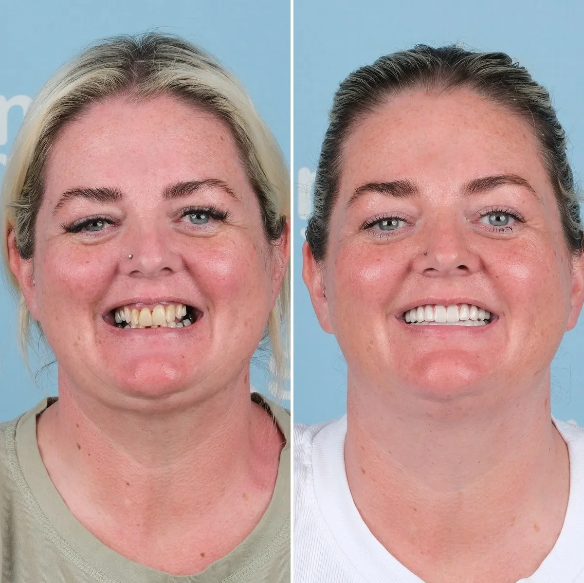 Annette before and after all-on-6 with UK Smiles