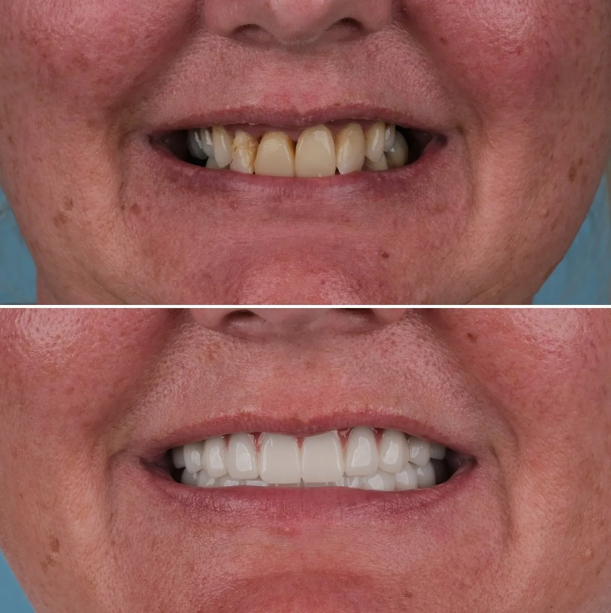 Close-up of Annette's teeth before and after All-on-6, view 1