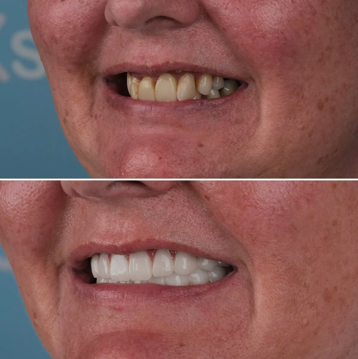 Close-up of Annette's teeth before and after All-on-6, view 2