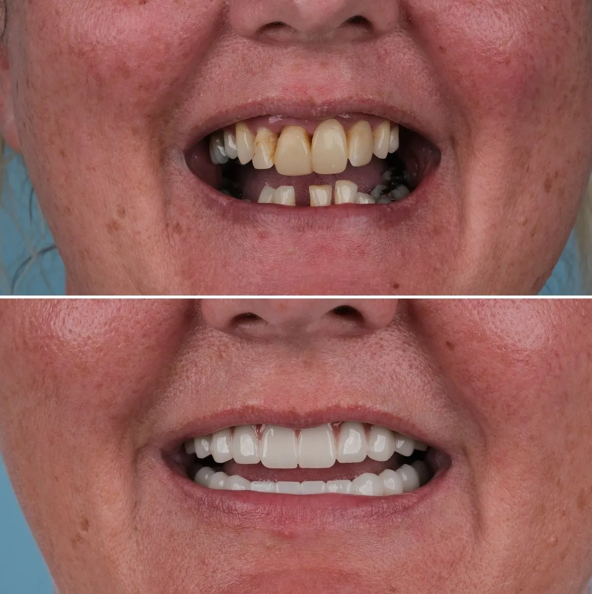 Close-up of Annette's teeth before and after All-on-6, view 3