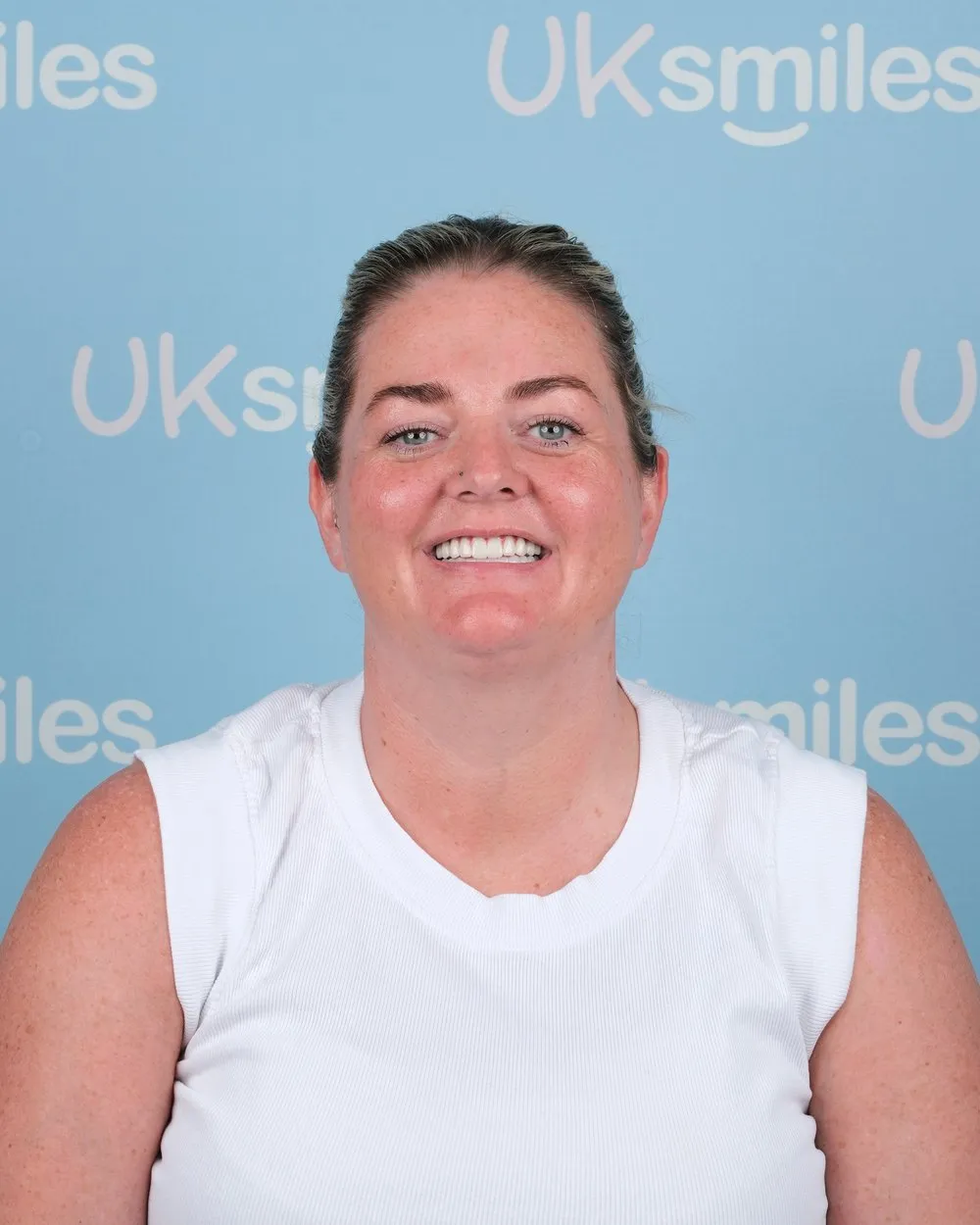Annette after All-on-6 with UK Smiles in Antalya
