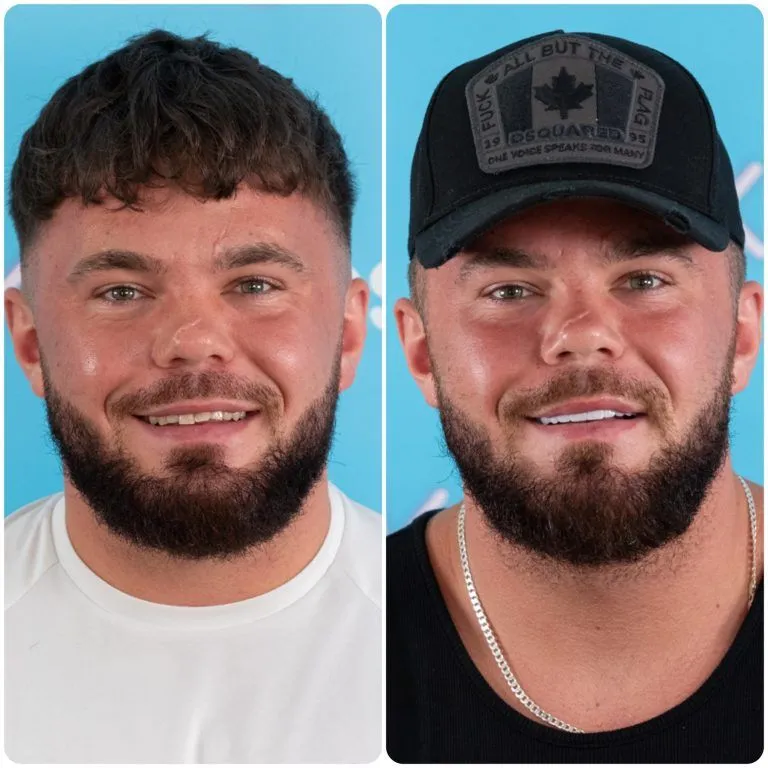 Bearded man before and after his new teeth, pictured in a cap afterwards