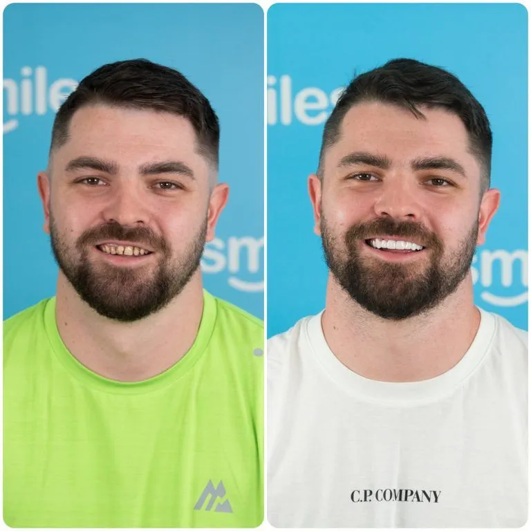 Before and after zirconia crowns on a bearded UK Smiles patient in a green t-shirt