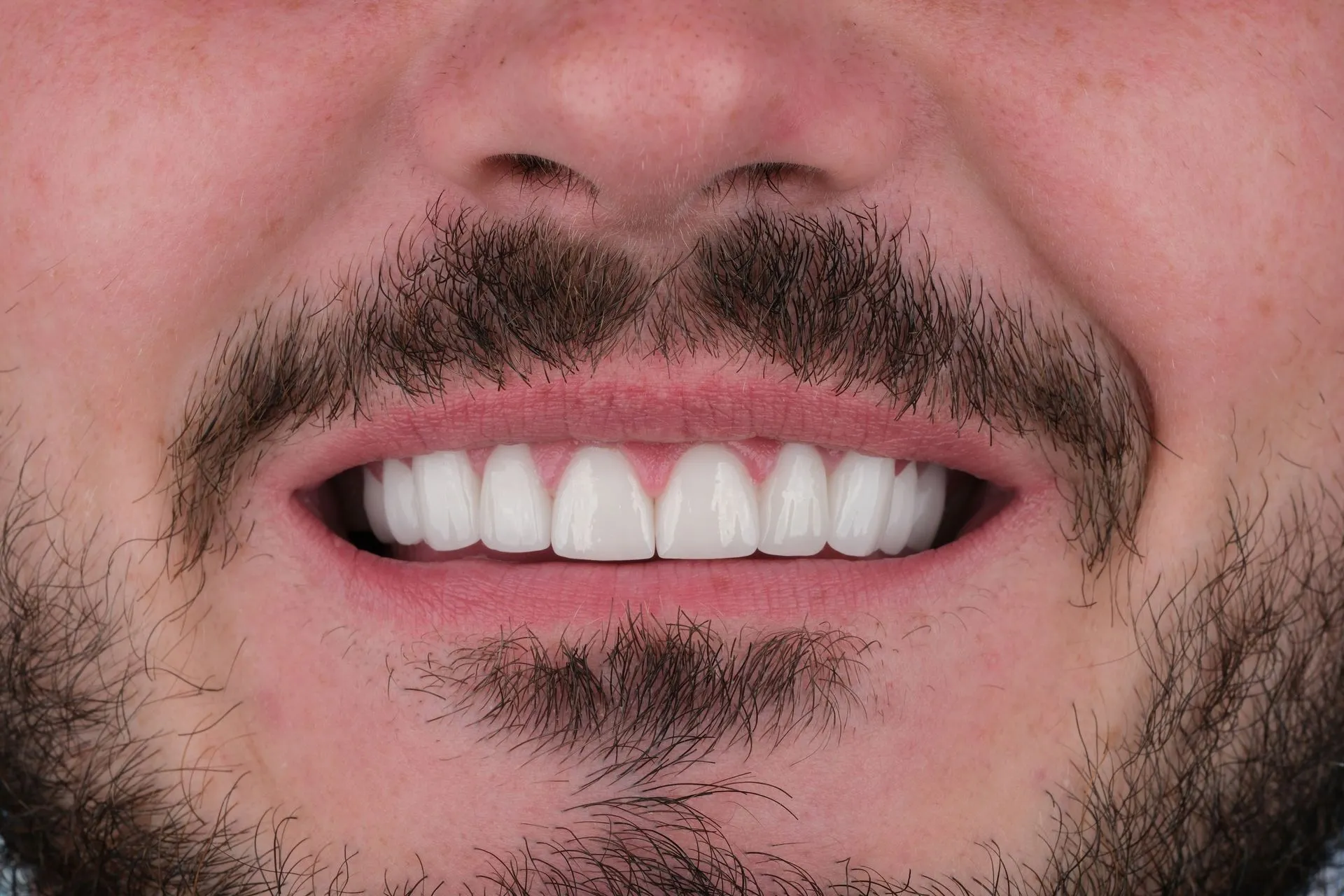 Close-up of a bearded man's new white smile