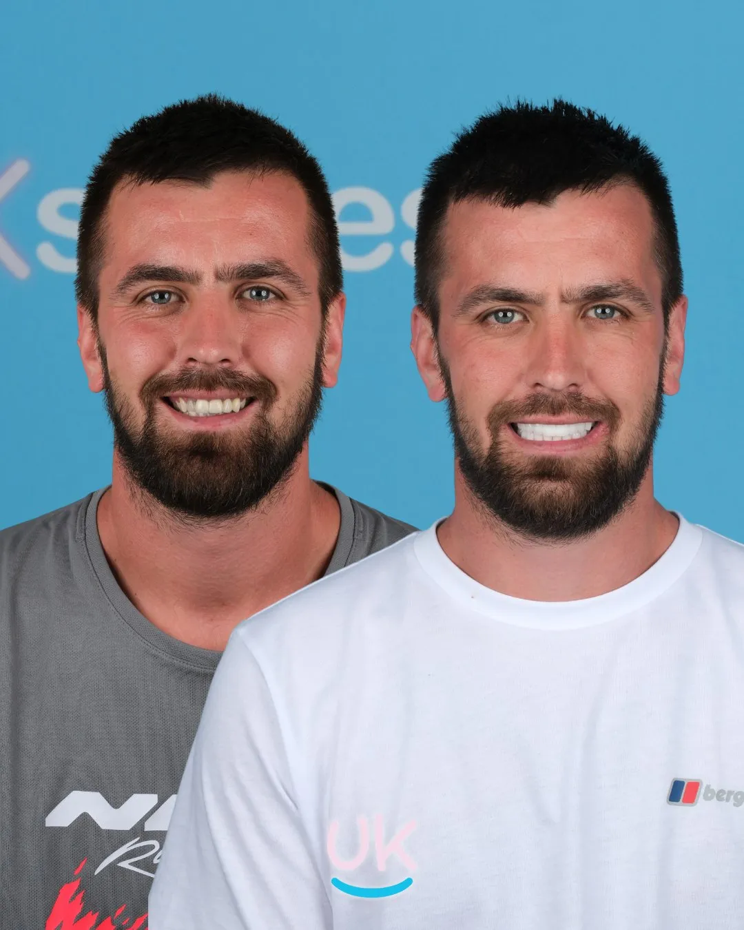 Bearded man before and after his new teeth, wearing a white T-shirt