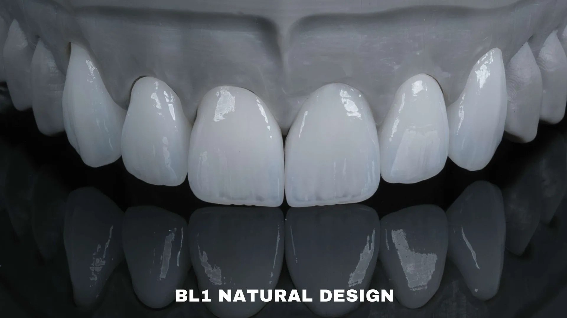 Dental model of BL1 veneers in the natural design