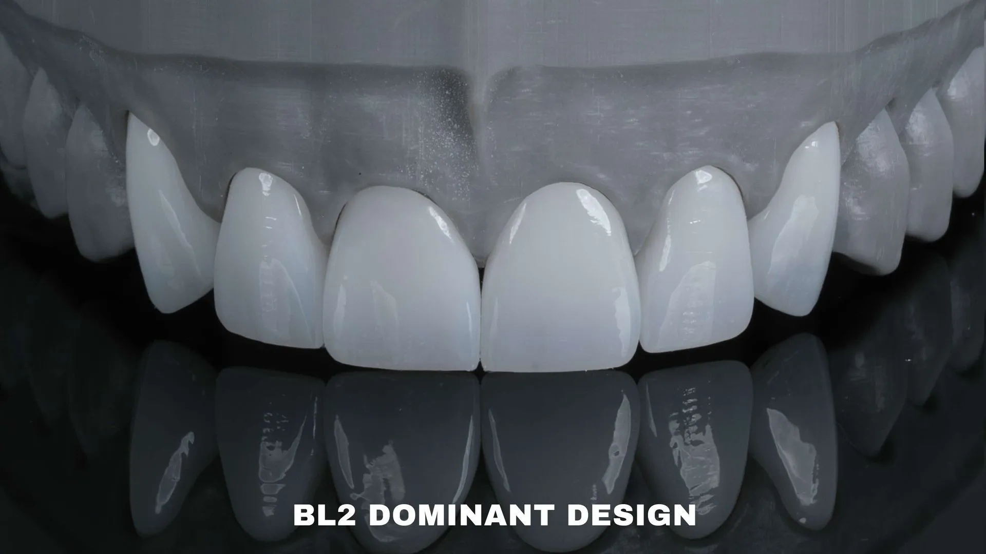 Dental model of BL2 veneers in the dominant design