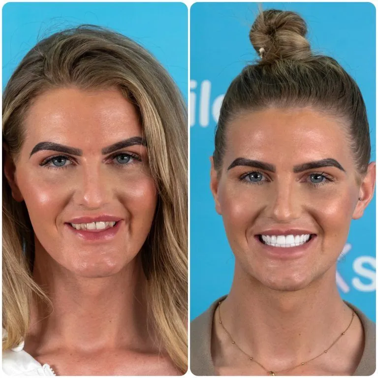 Blonde woman before and after her new smile, hair up in a bun afterwards