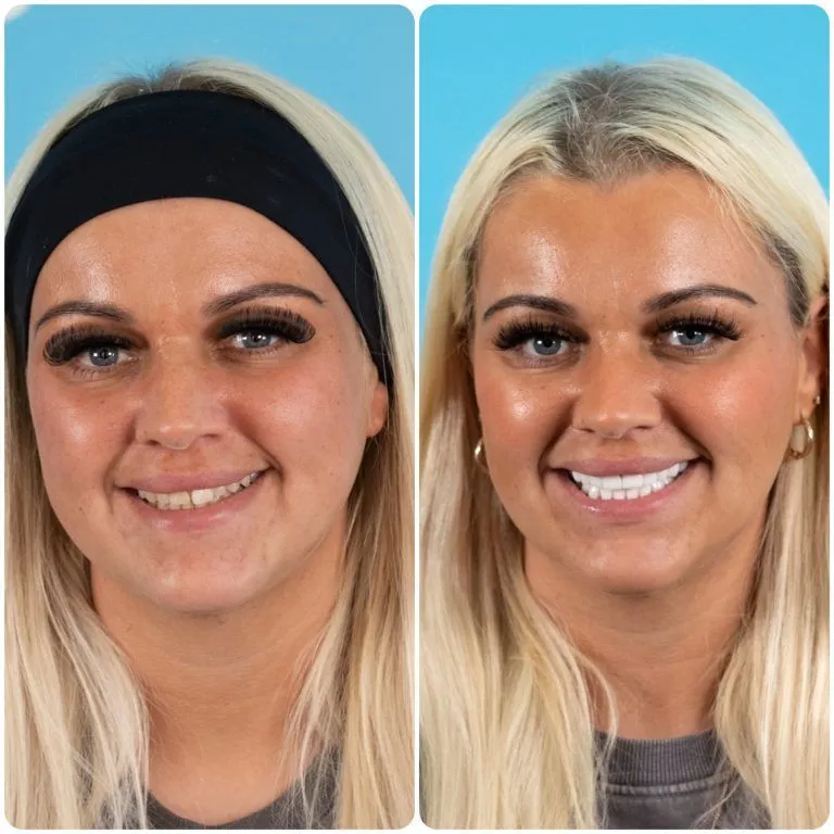 Blonde woman in a headband before and after her new smile