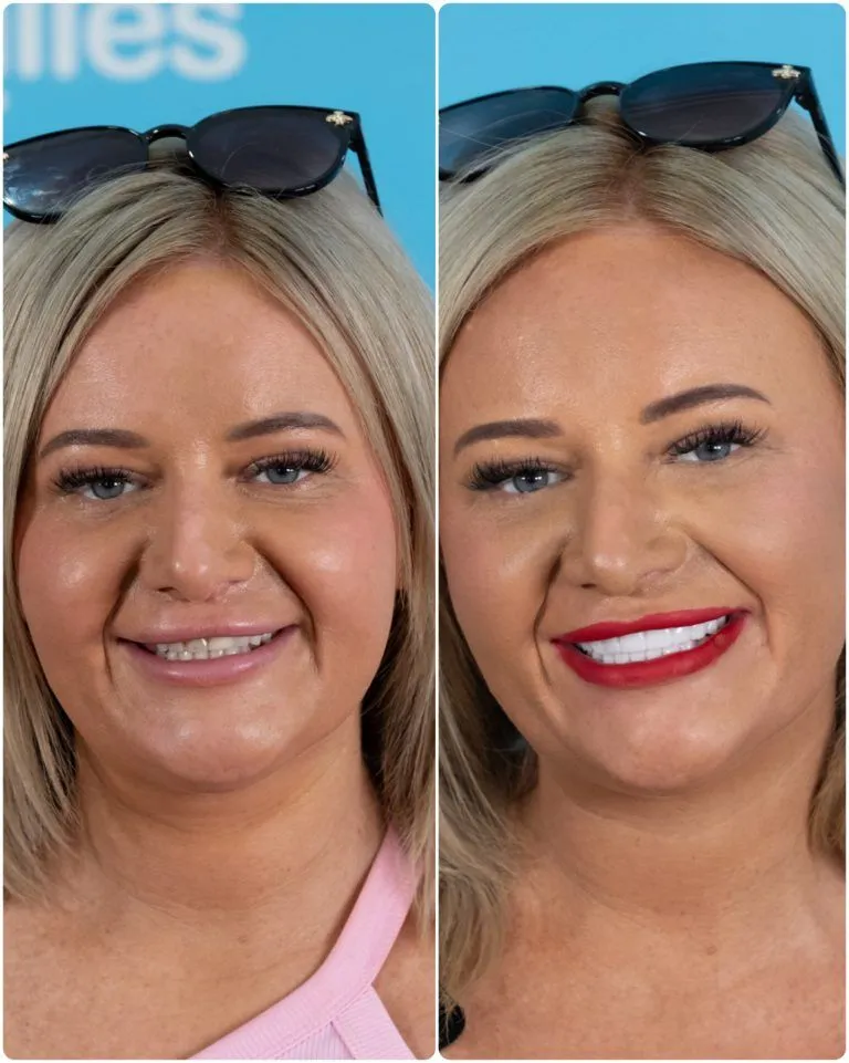 Blonde woman with sunglasses before and after her new smile