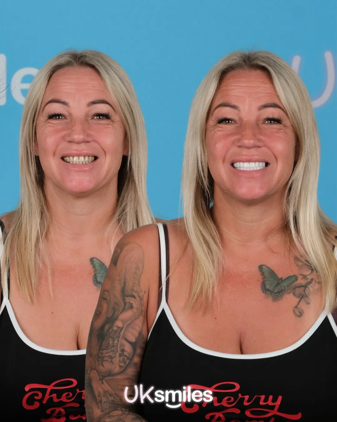 Blonde woman with tattoos before and after her smile makeover at UK Smiles