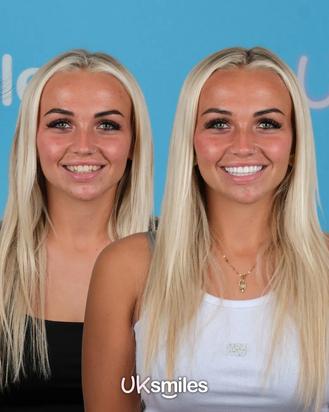 Blonde woman in a white top before and after brighter, even teeth