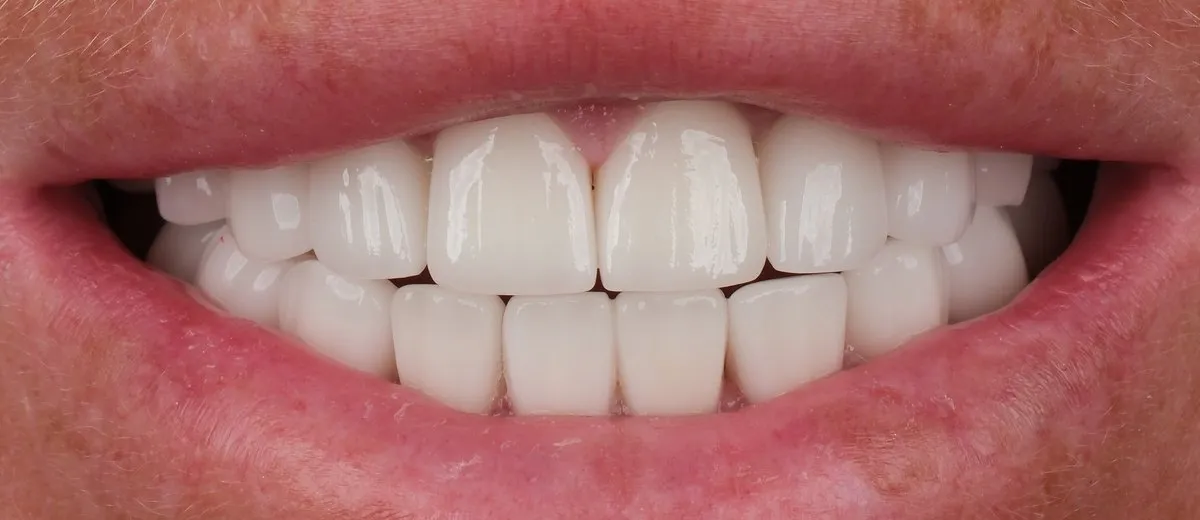 A UK Smiles patient's smile after treatment: BL2 shade, Hollywood style