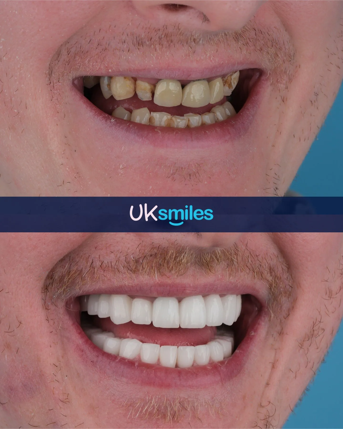 Close-up of crowded, stained teeth before and a straight white smile after