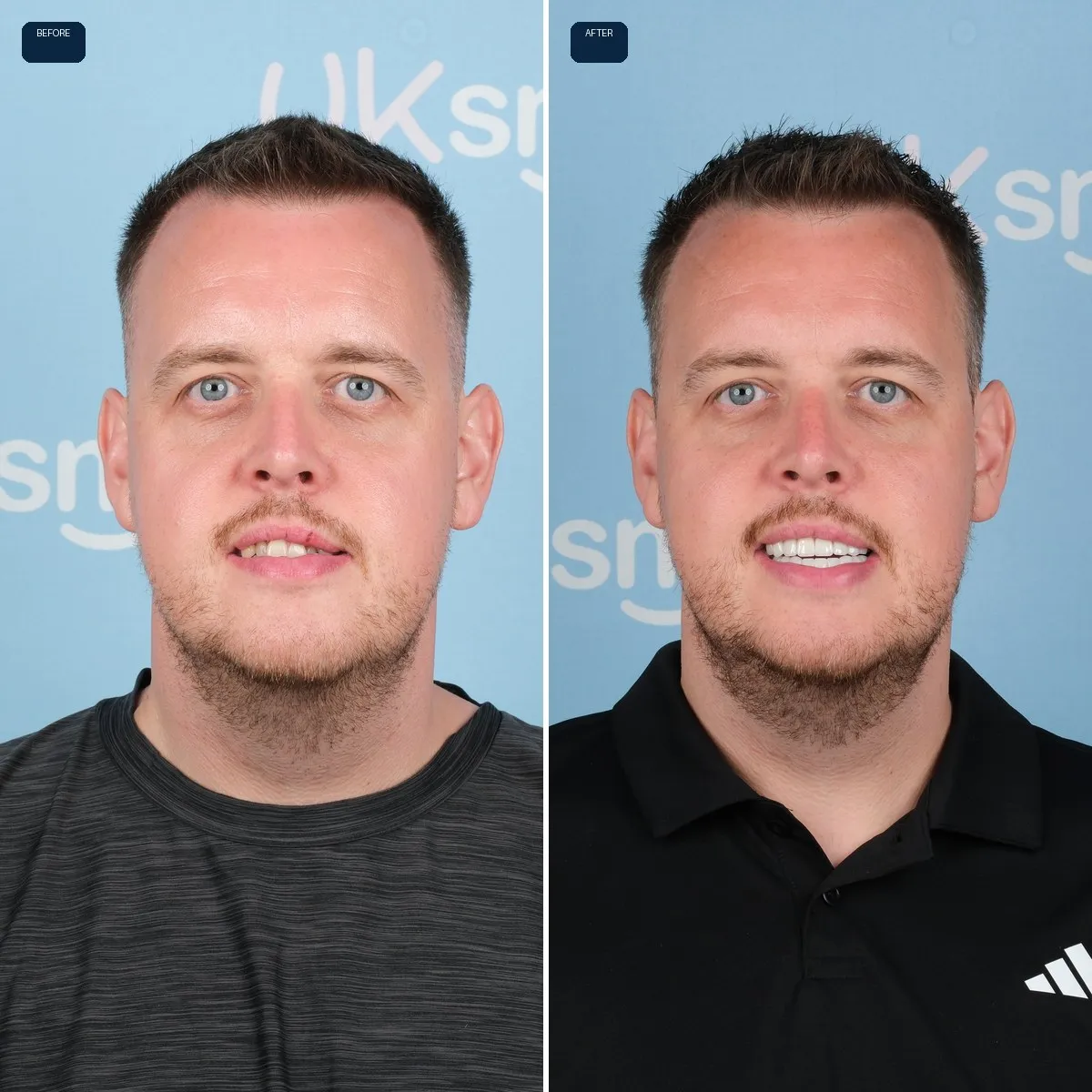 Daniel's face before and after Zirconium Crowns at UK Smiles in Antalya