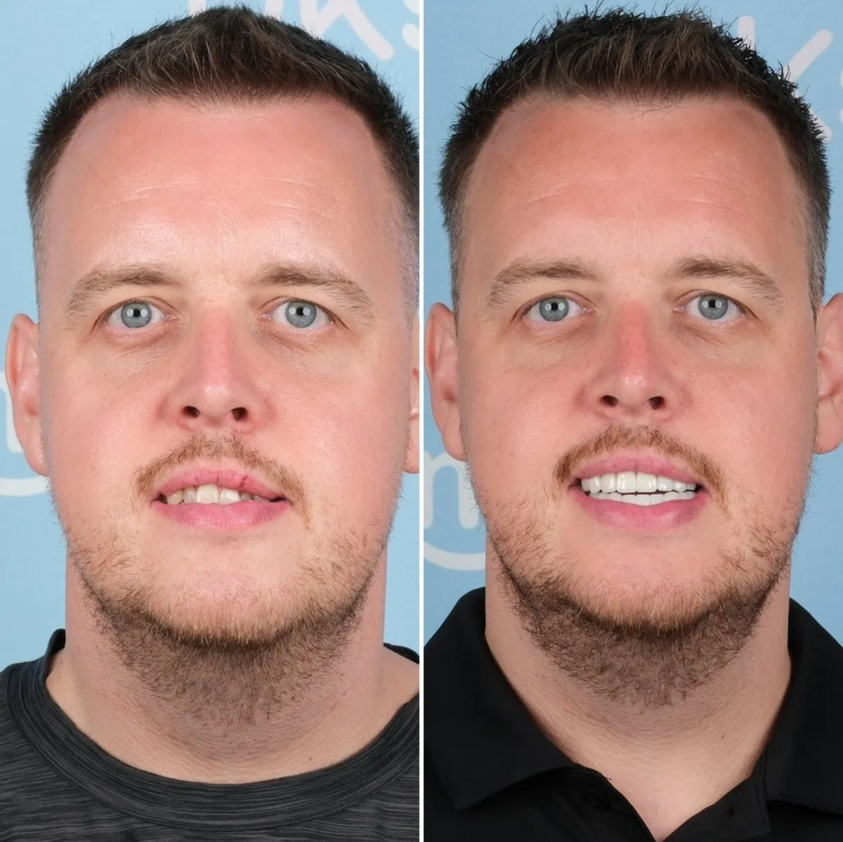 Daniel before and after zirconium crowns with UK Smiles