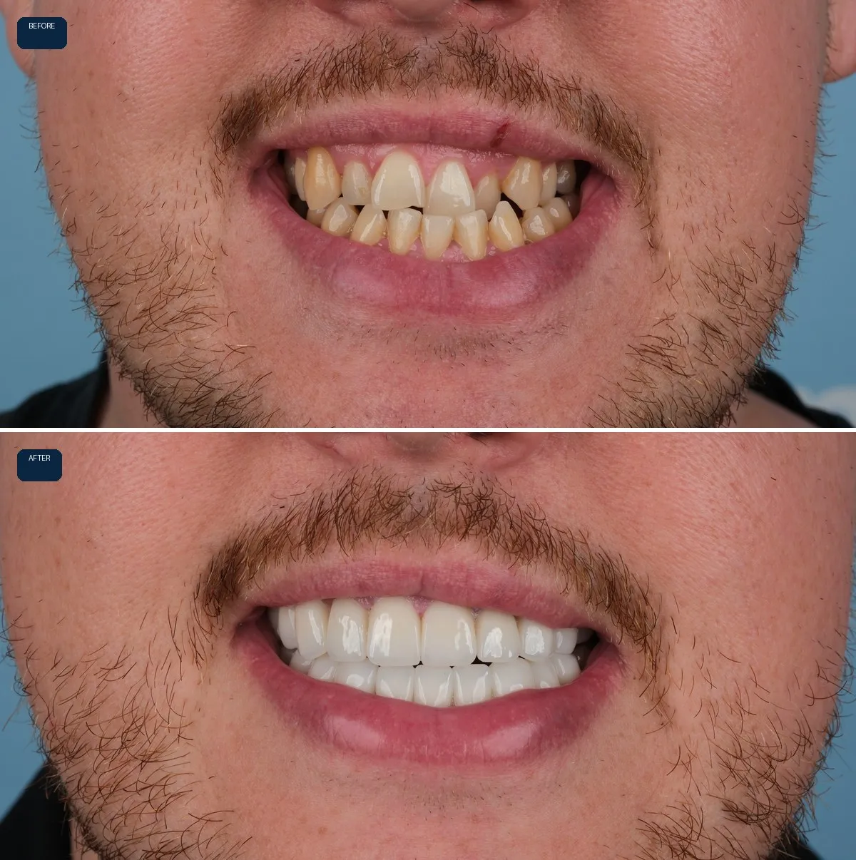 Close-up of Daniel's teeth before and after Zirconium Crowns, view 1
