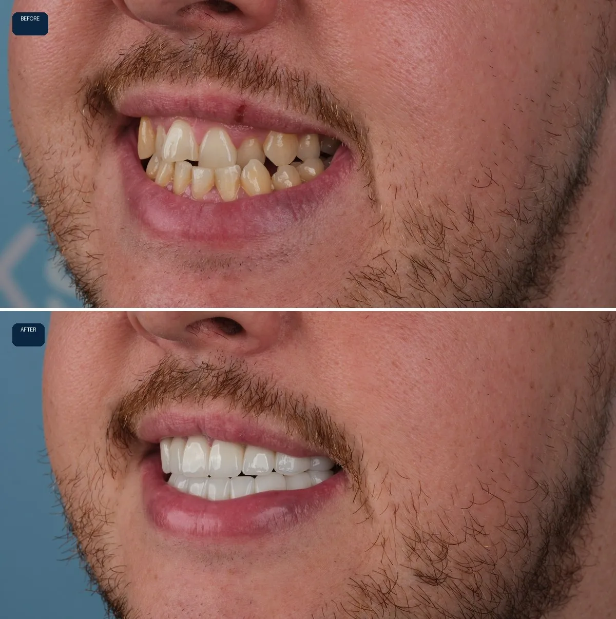 Close-up of Daniel's teeth before and after Zirconium Crowns, view 2