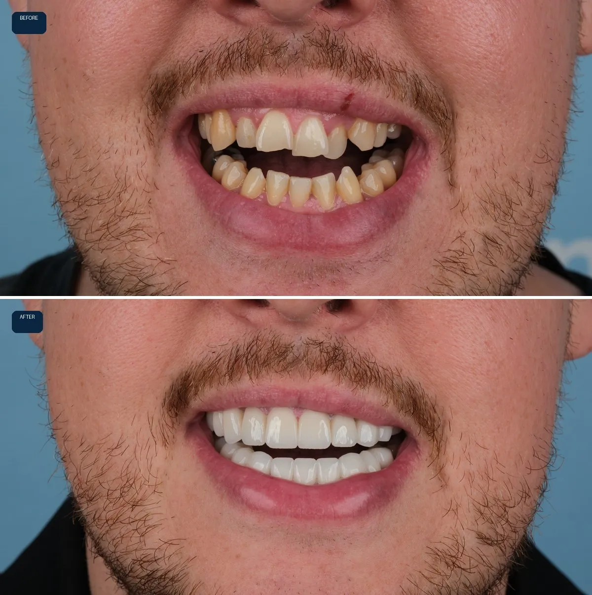 Close-up of Daniel's teeth before and after Zirconium Crowns, view 3