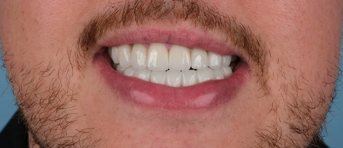 Daniel after Full set of zirconia crowns with UK Smiles
