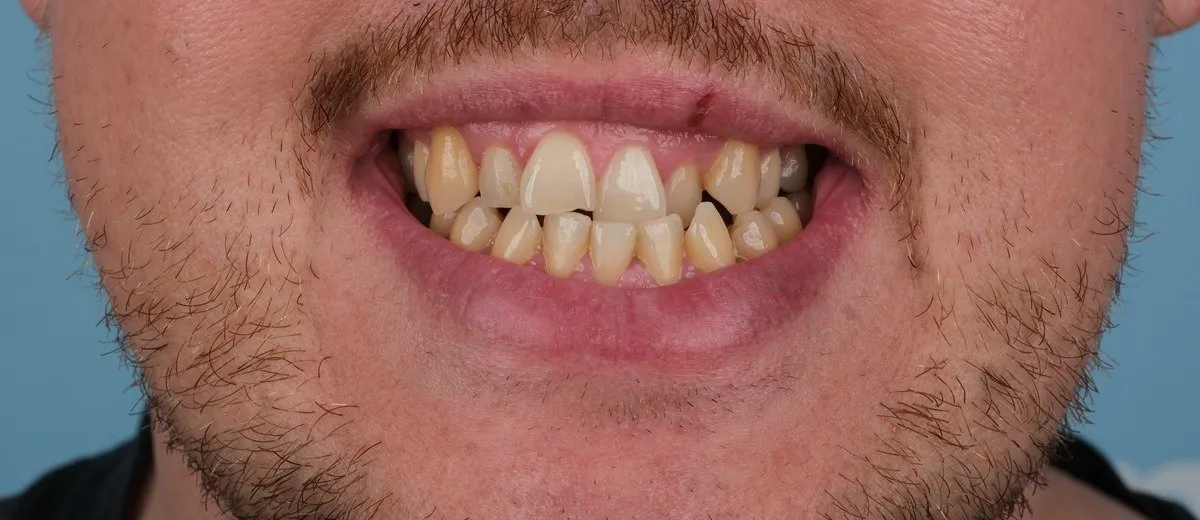 Daniel before Full set of zirconia crowns with UK Smiles