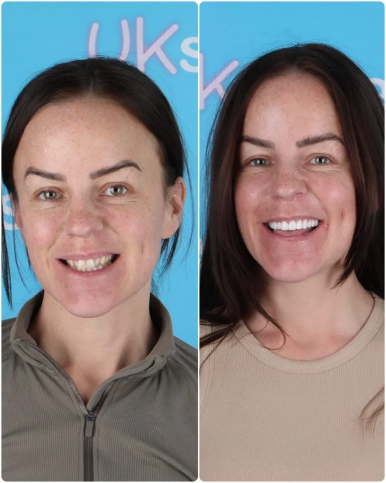 Dark-haired woman before and after her new smile at UK Smiles