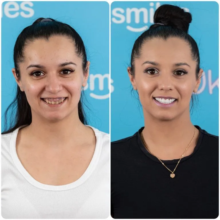 Dark-haired woman with a ponytail before and after her new smile