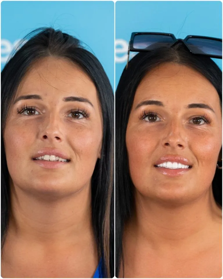 Dark-haired woman before and after her new smile, with sunglasses on her head