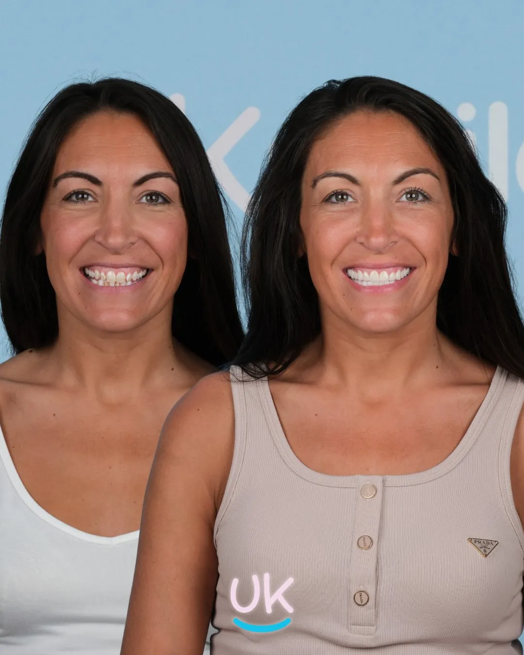Dark-haired woman smiling before and after her new teeth at UK Smiles