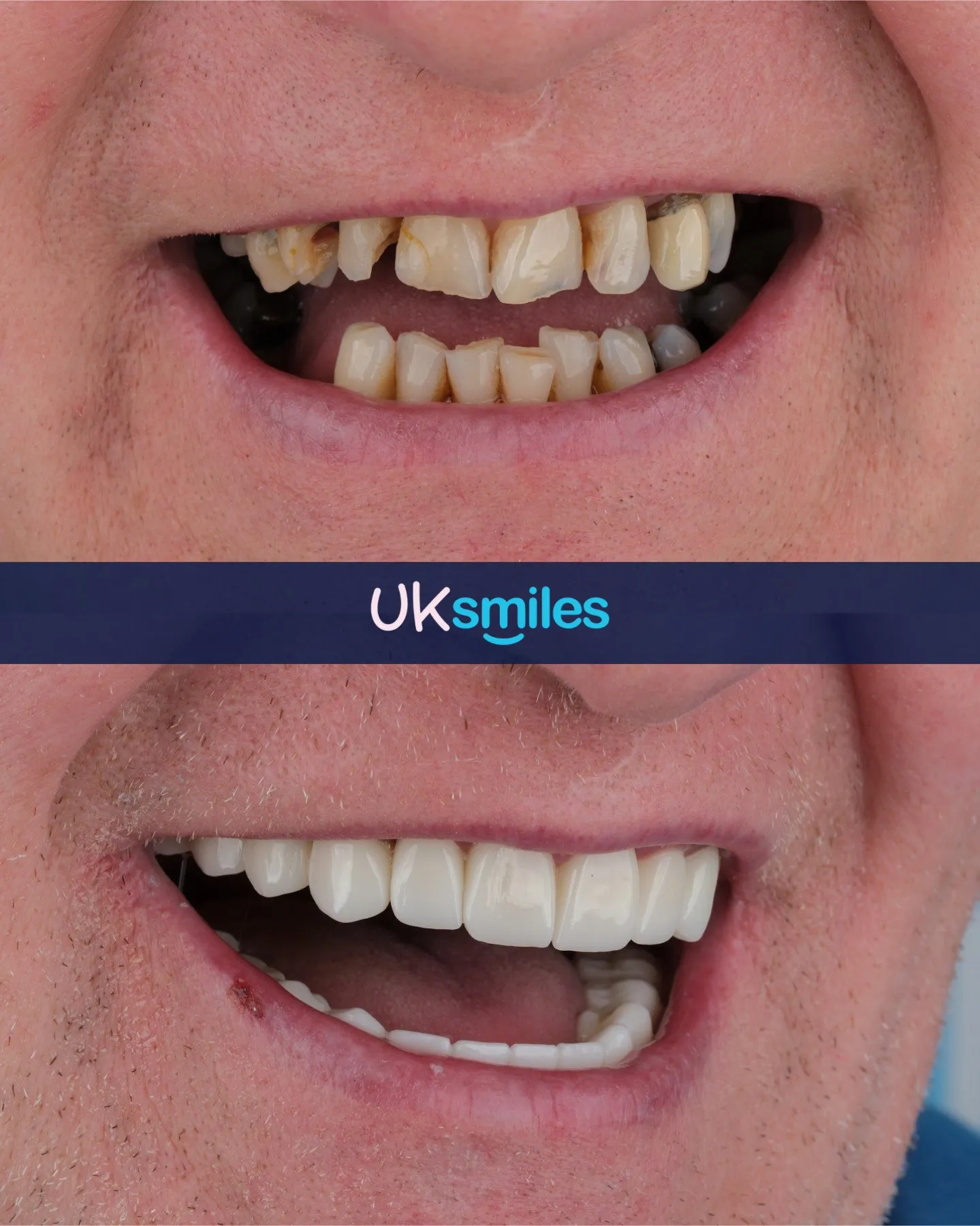 Close-up of decayed and missing teeth before and a full new smile after treatment in Turkey