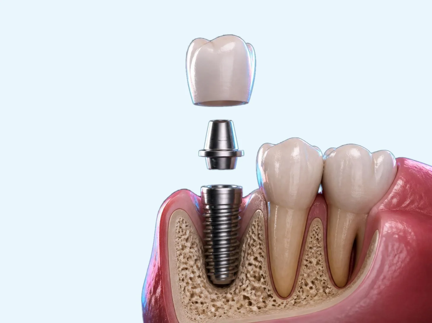 3D illustration of a dental implant in the jawbone, with the abutment and crown shown above it