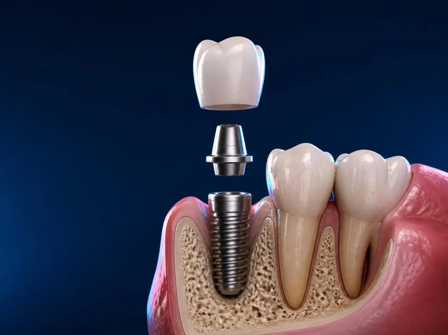 UK Smiles diagram of a dental implant: titanium implant in the jawbone, abutment, and zirconia crown on top