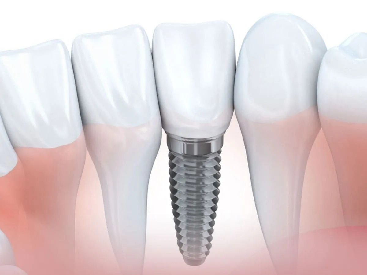 Illustration of a dental implant with a crown sitting in the gum between natural teeth