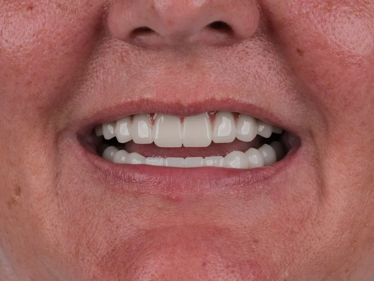 Close-up of a UK Smiles patient smiling after dental implant treatment
