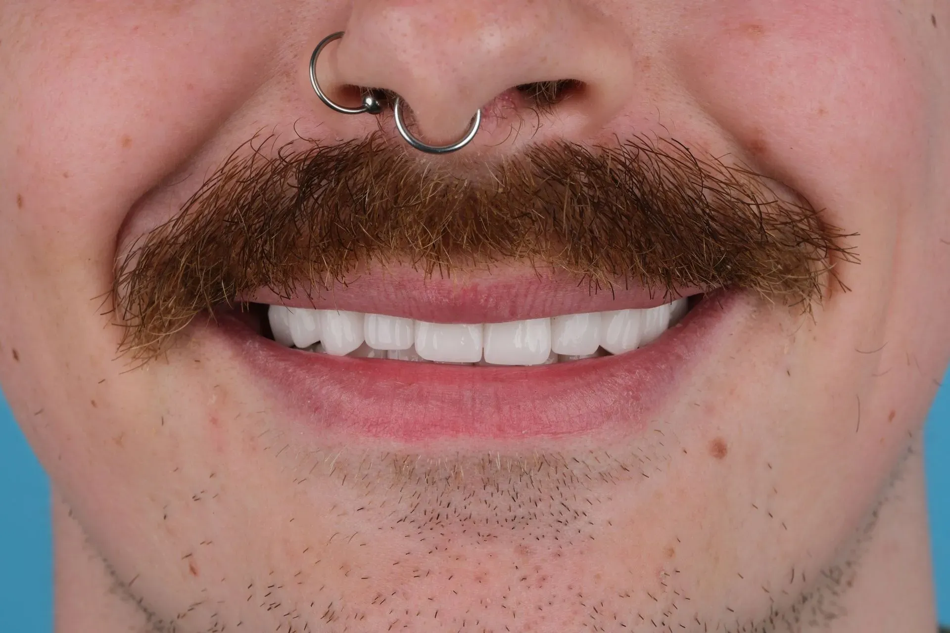 Close-up of a man with a mustache and nose ring smiling, showing white teeth after dental implants